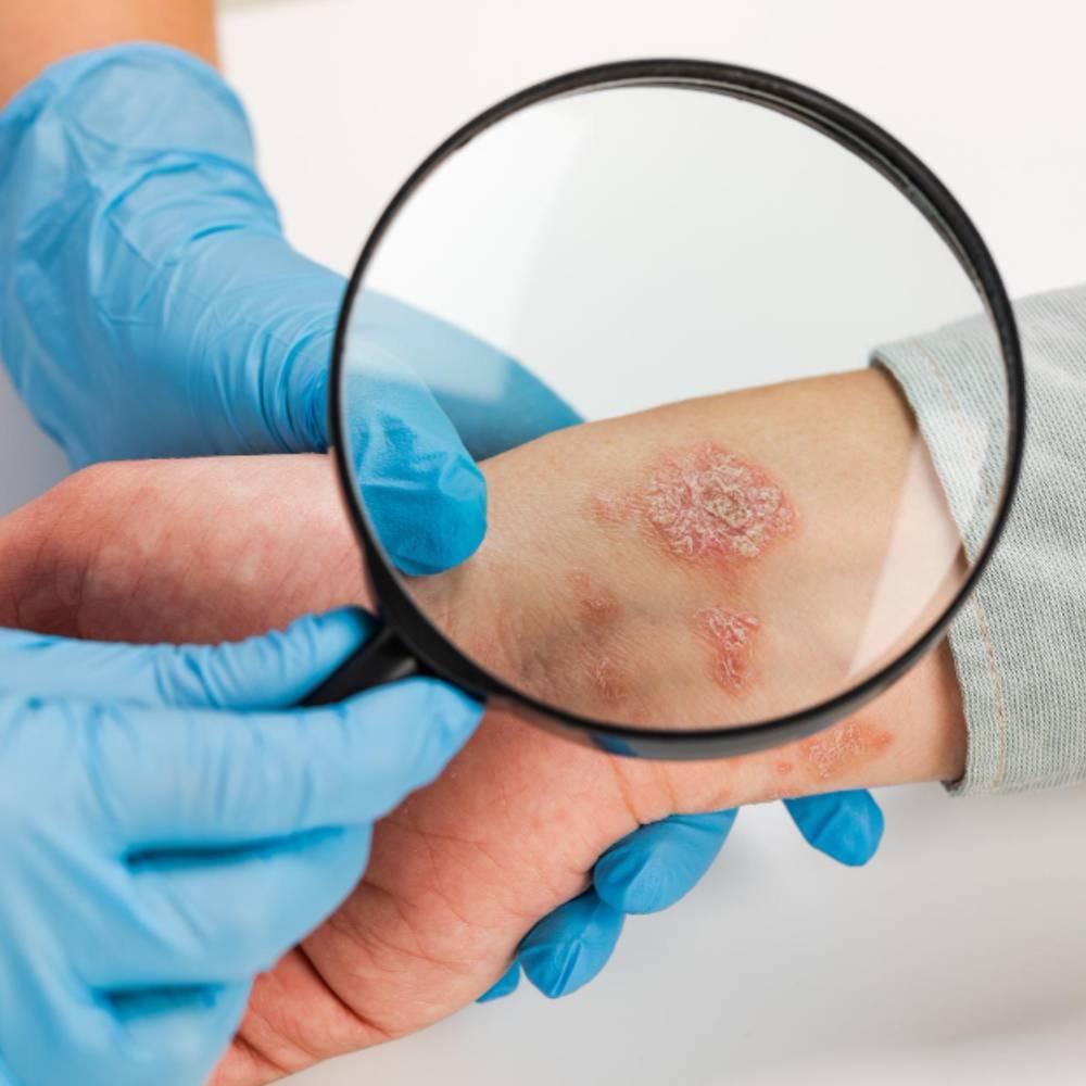 Eczema Treatment