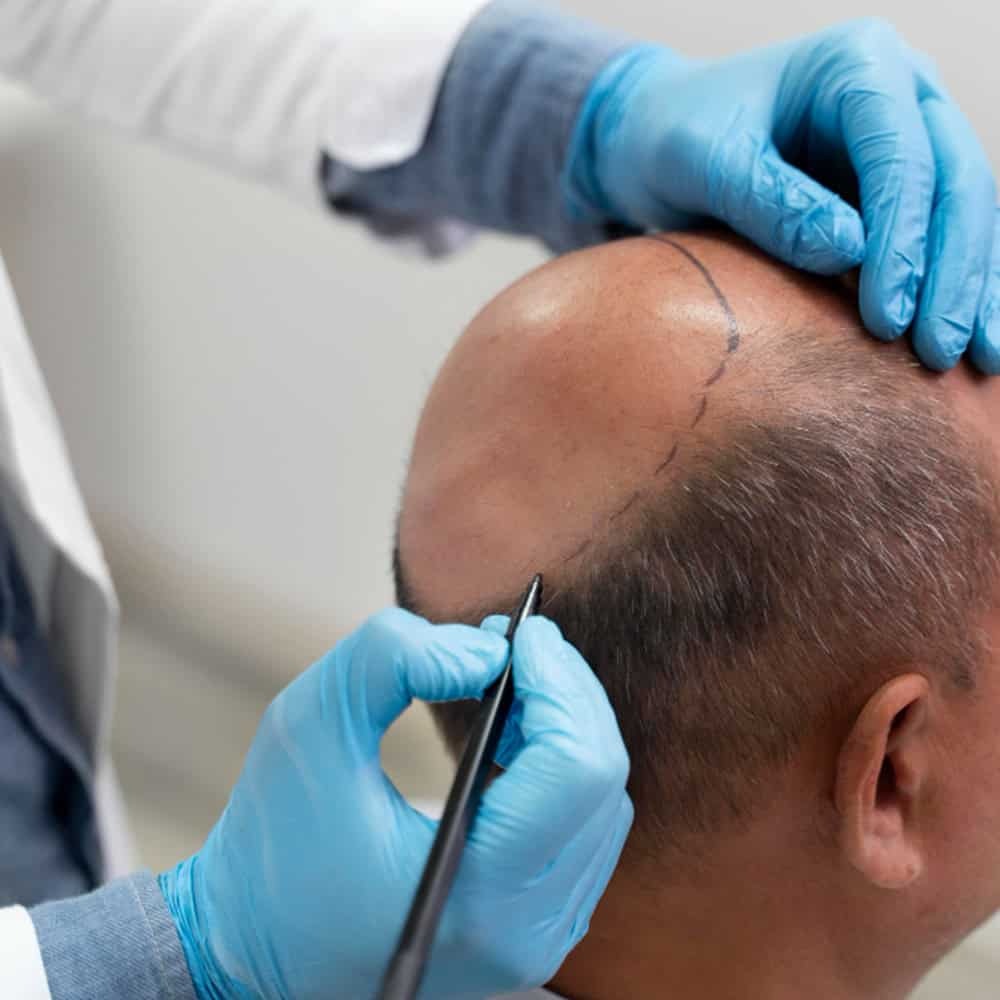 Hair Transplant