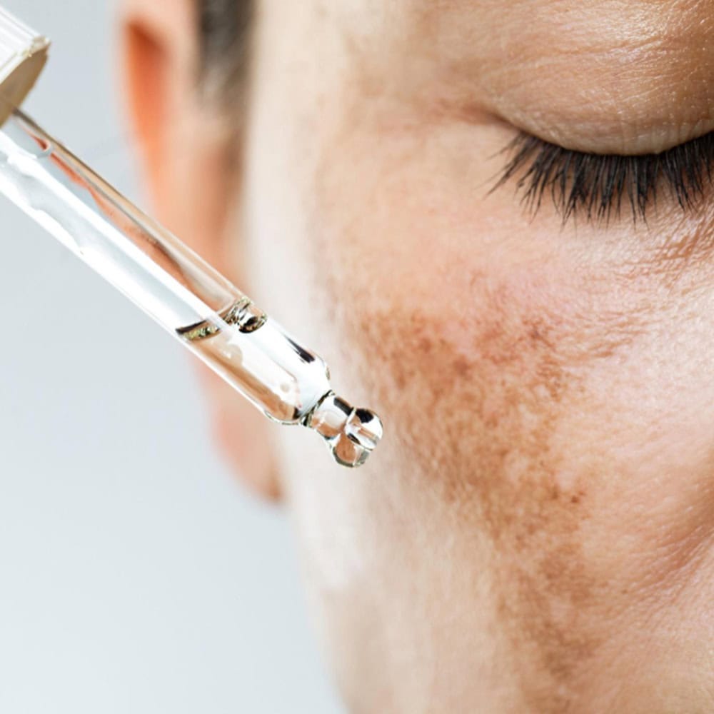 Melasma Treatment