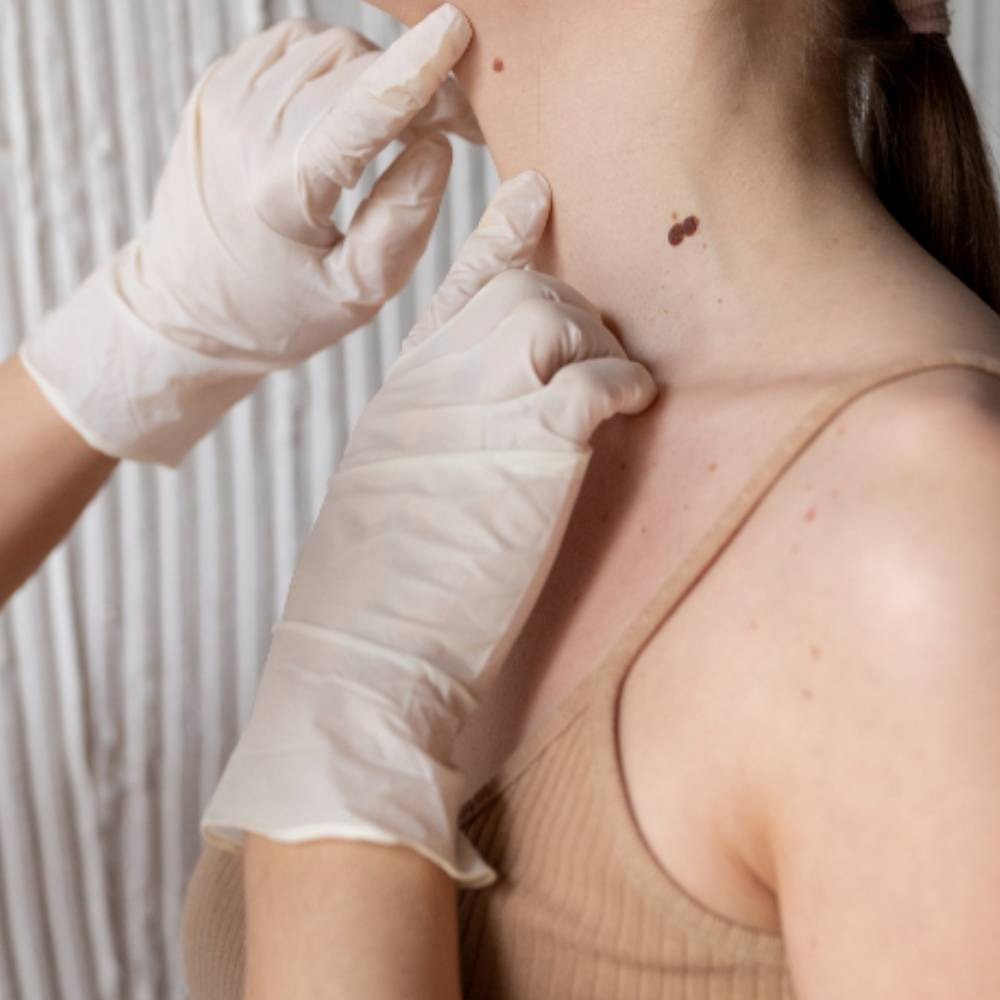 Warts Removal